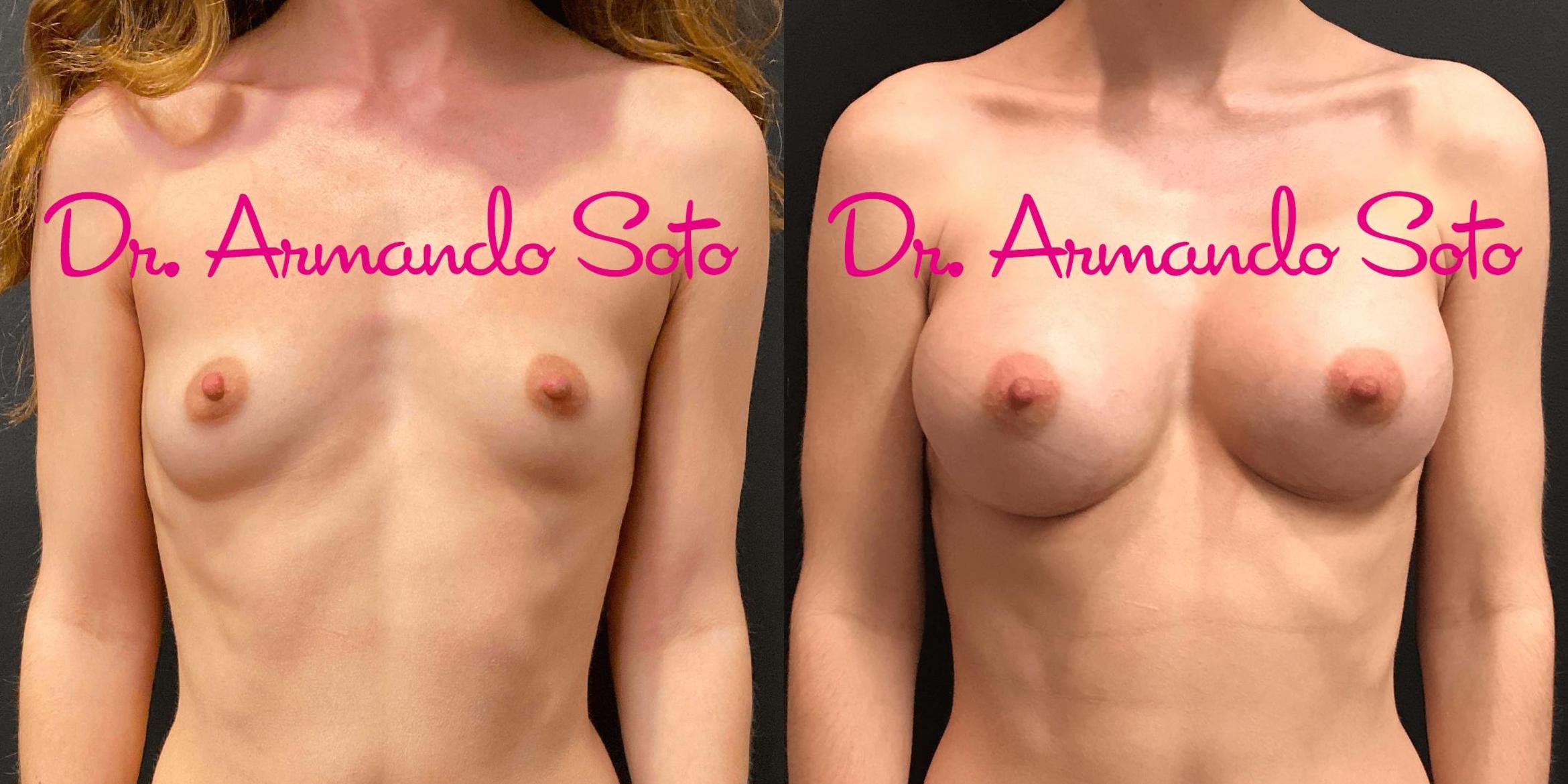 Before & After Breast Augmentation Case 67181 View #1 View in Orlando, FL