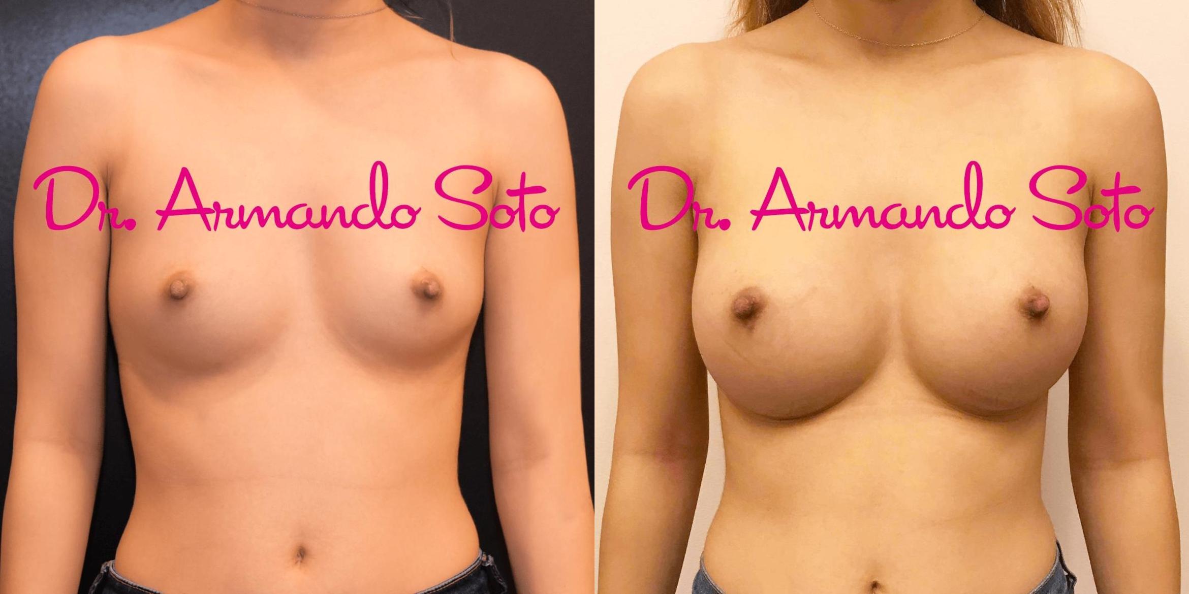 Before & After Breast Augmentation Case 69064 View #1 View in Orlando, FL