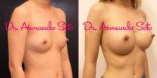 Before & After Breast Augmentation Case 69064 View #2 View in Orlando, FL