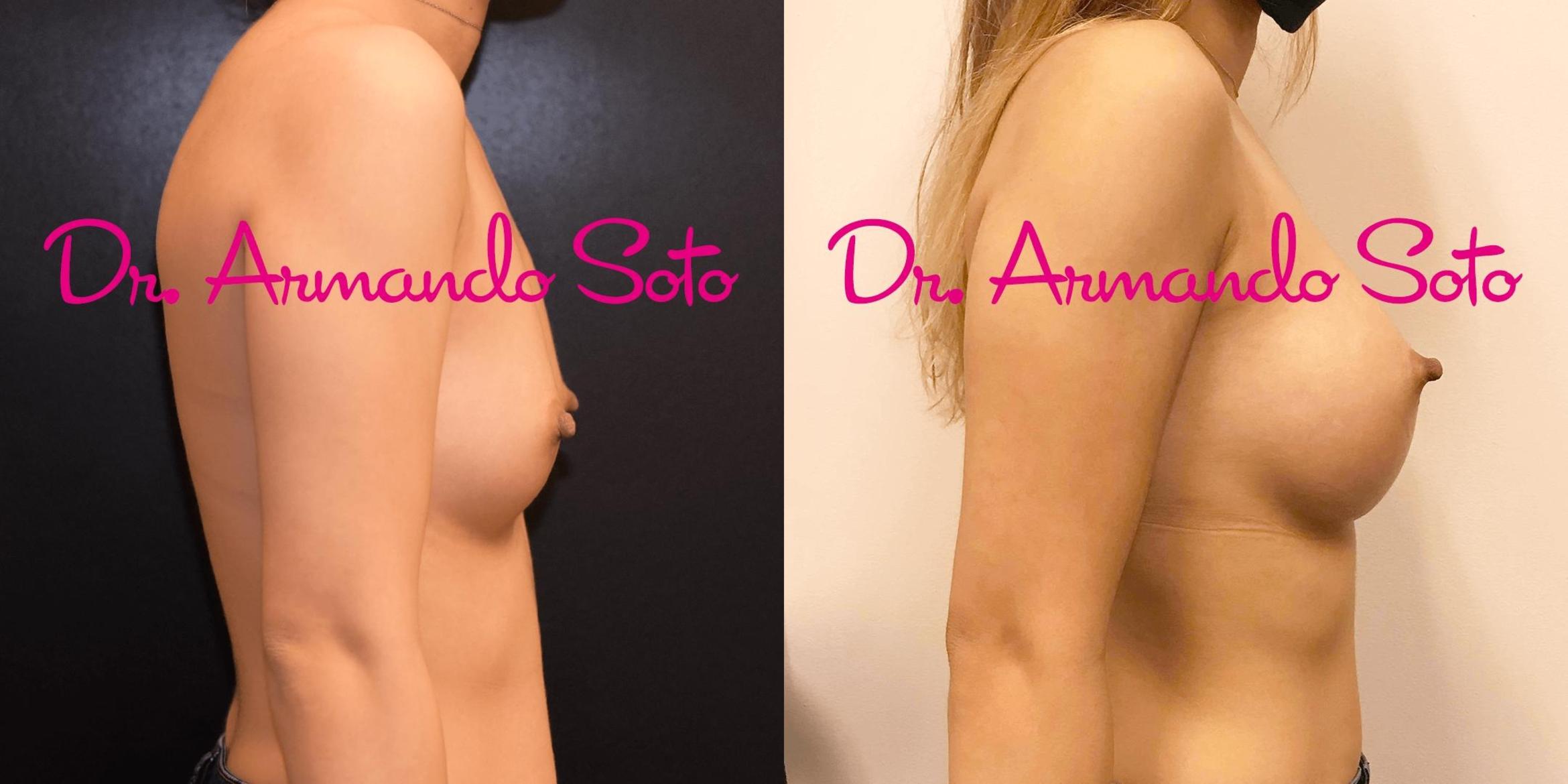 Before & After Breast Augmentation Case 69064 View #3 View in Orlando, FL