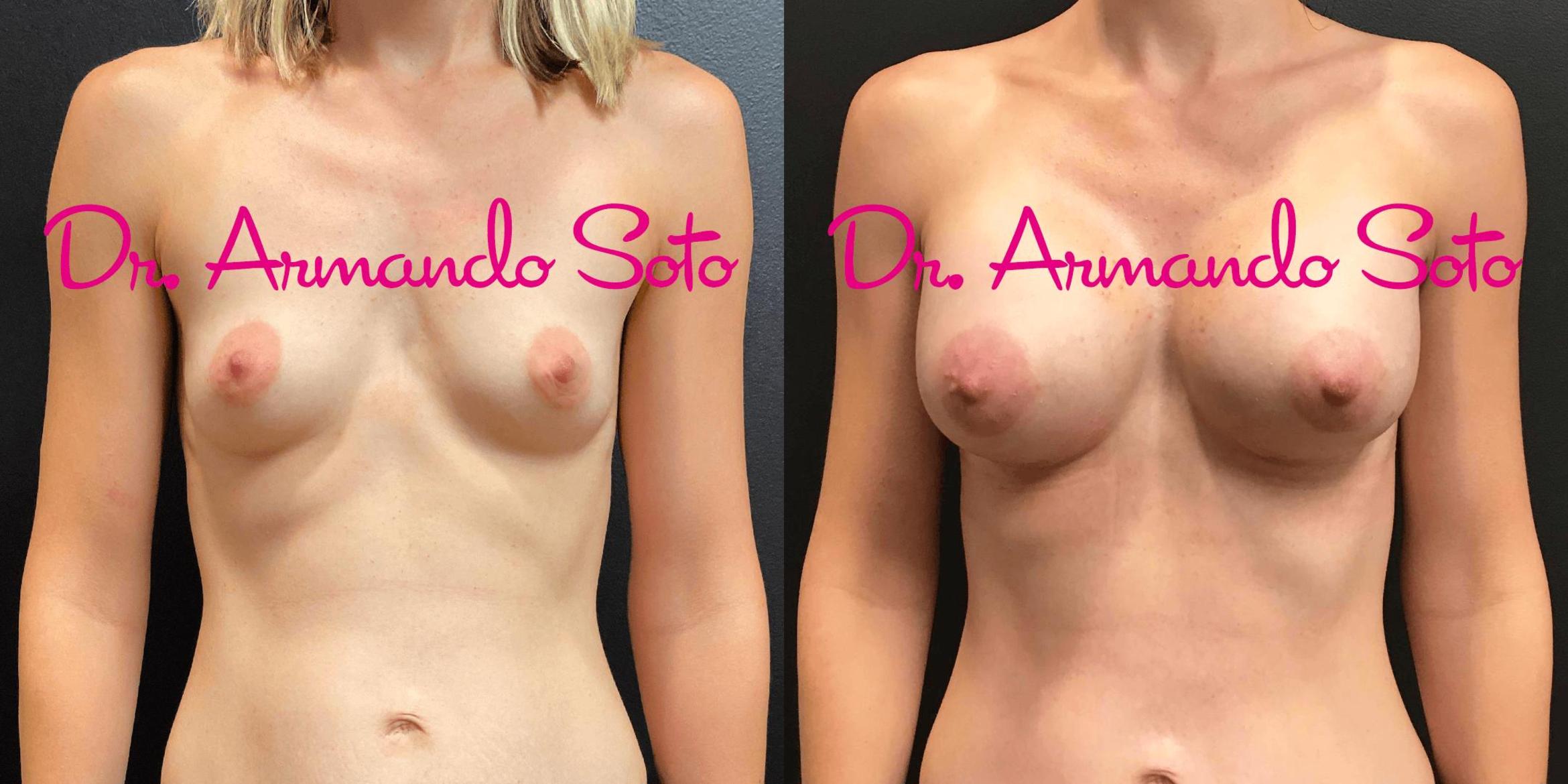 Before & After Breast Augmentation Case 70311 View #1 View in Orlando, FL