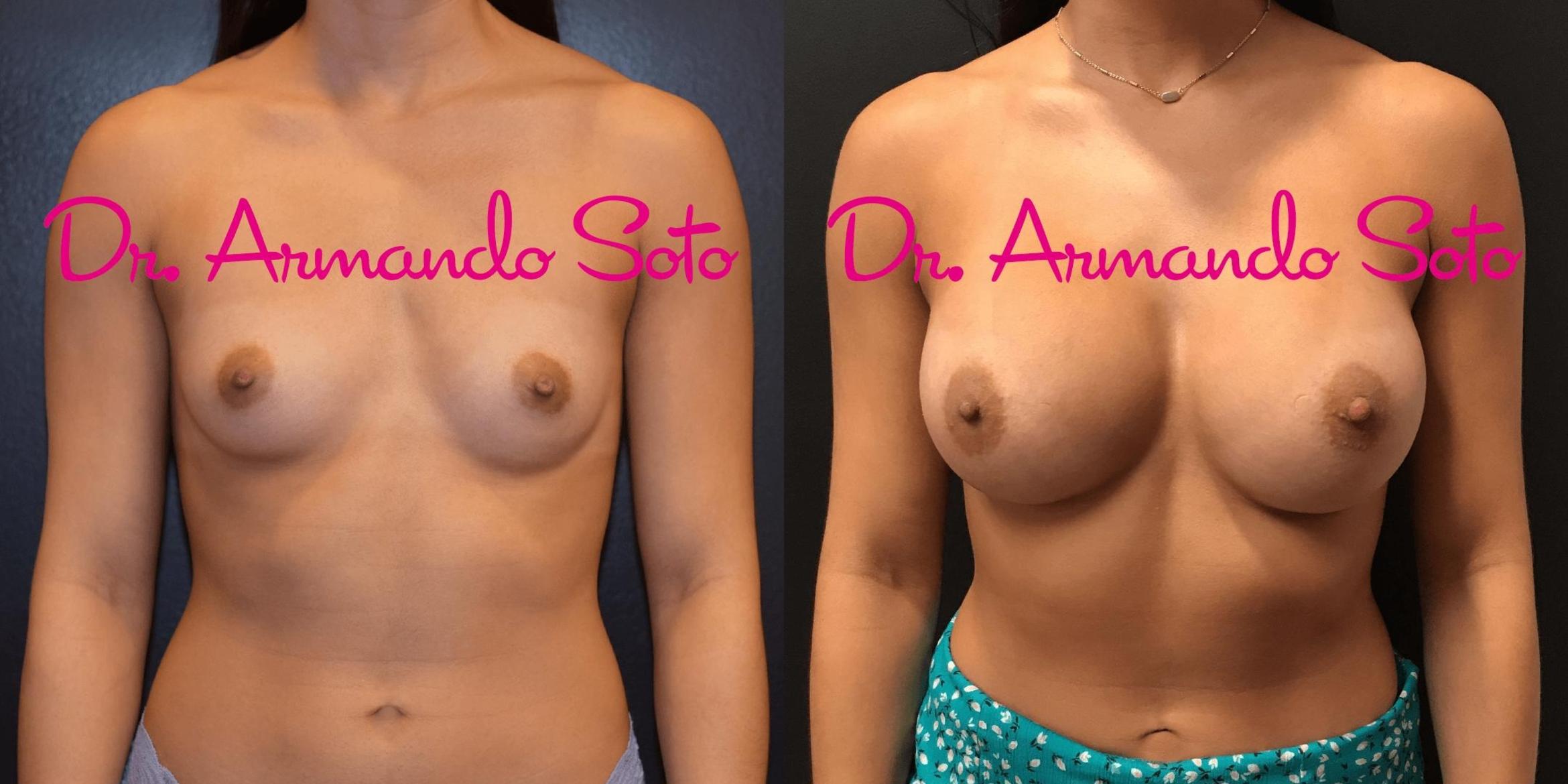 Before & After Breast Augmentation Case 70598 View #1 View in Orlando, FL