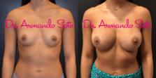 Before & After Breast Augmentation Case 70598 View #1 View in Orlando, FL