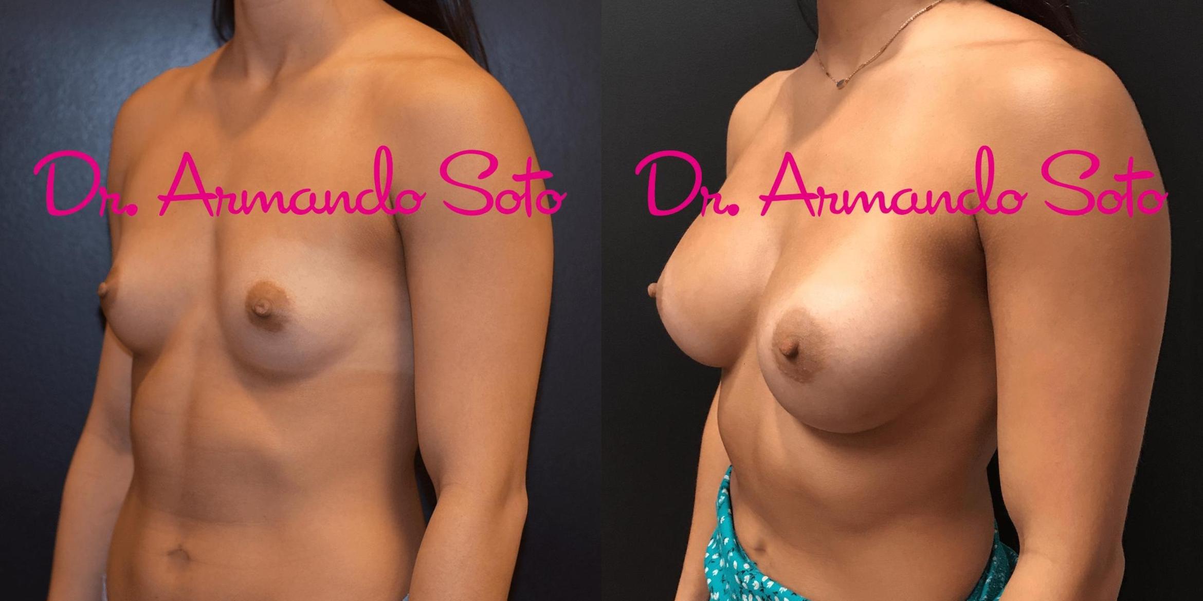 Before & After Breast Augmentation Case 70598 View #2 View in Orlando, FL