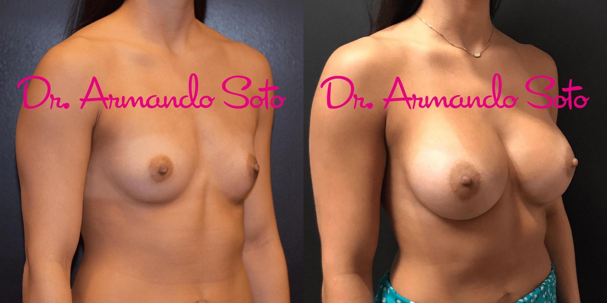 Before & After Breast Augmentation Case 70598 View #3 View in Orlando, FL