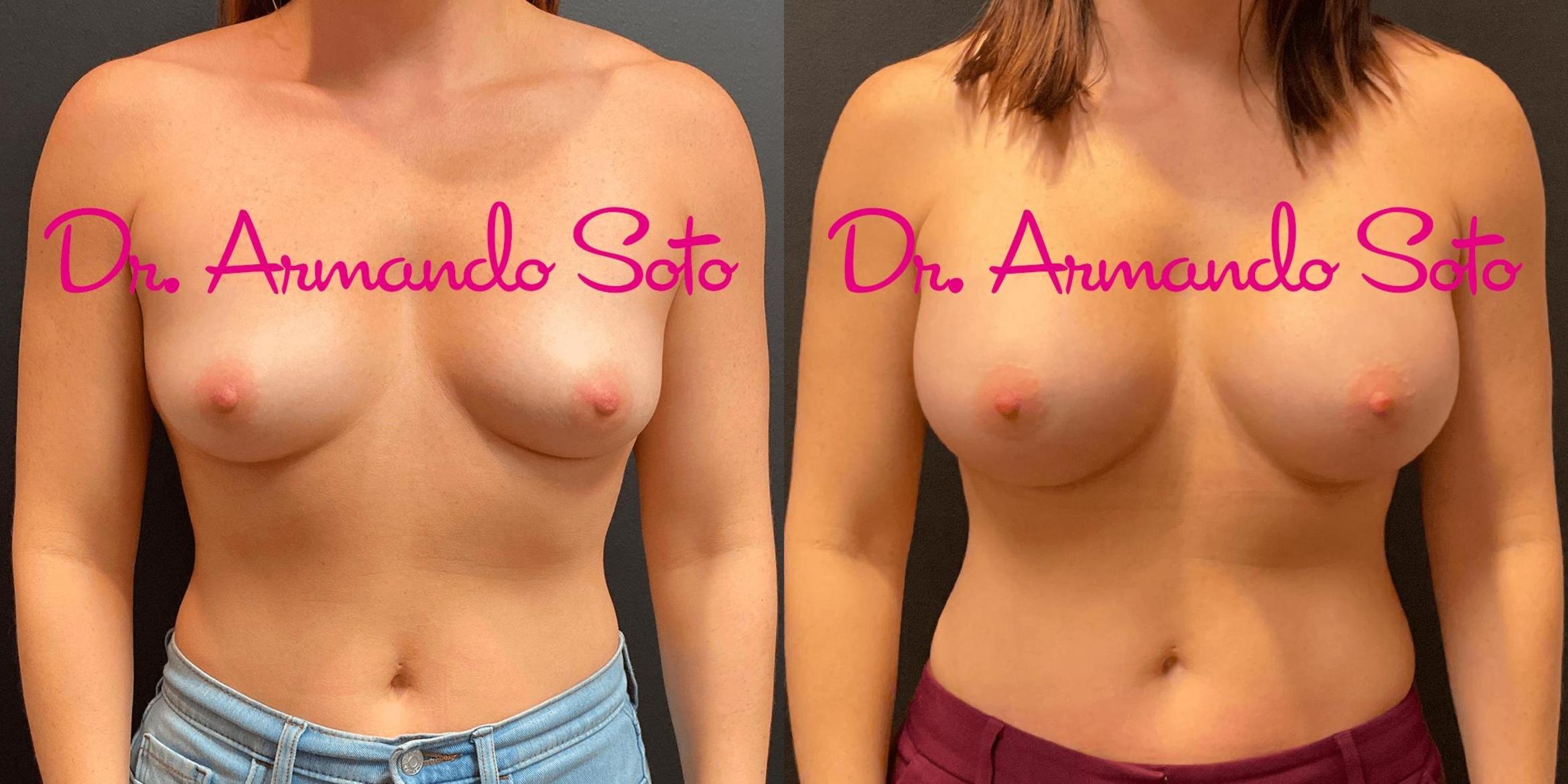 Before & After Breast Augmentation Case 71387 View #1 View in Orlando, FL