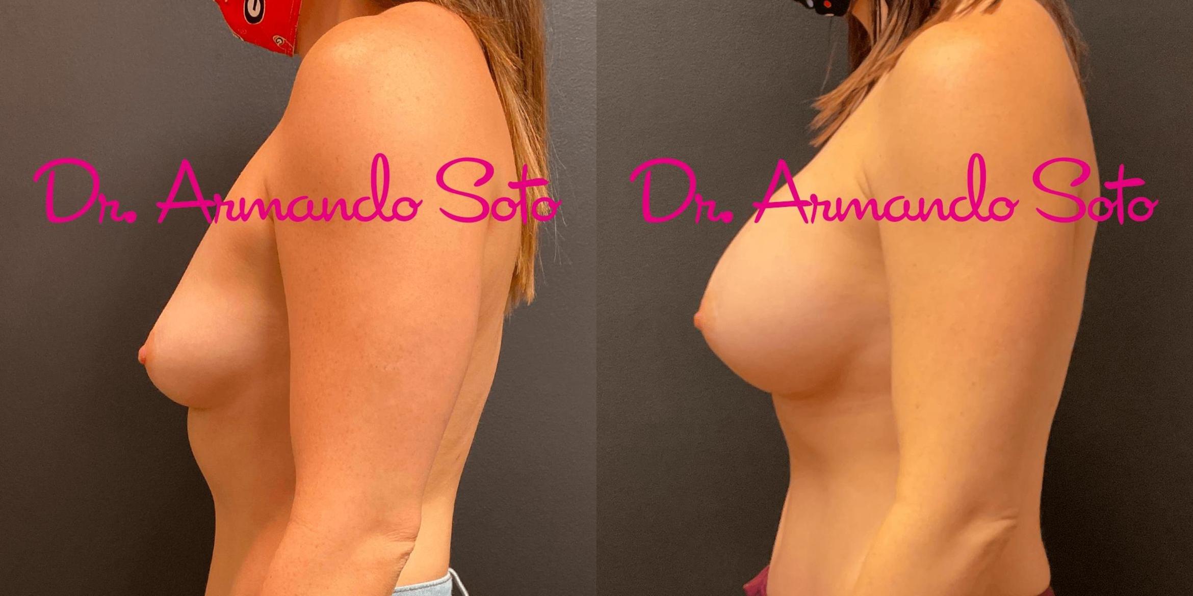 Before & After Breast Augmentation Case 71387 View #2 View in Orlando, FL