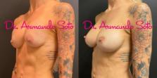 Before & After Breast Augmentation Case 71430 View #2 View in Orlando, FL