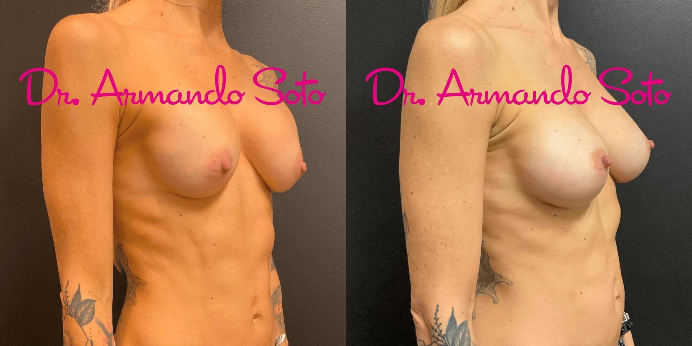 Before & After Breast Augmentation Case 71430 View #4 View in Orlando, FL