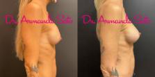 Before & After Breast Augmentation Case 71430 View #5 View in Orlando, FL
