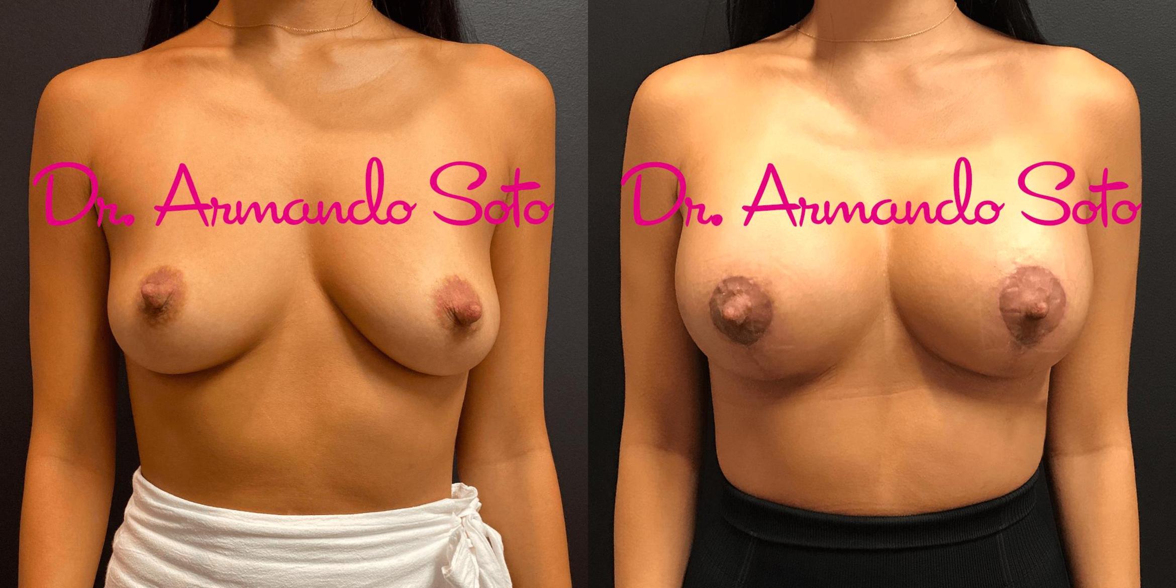 Before & After Breast Augmentation Case 71921 View #1 View in Orlando, FL