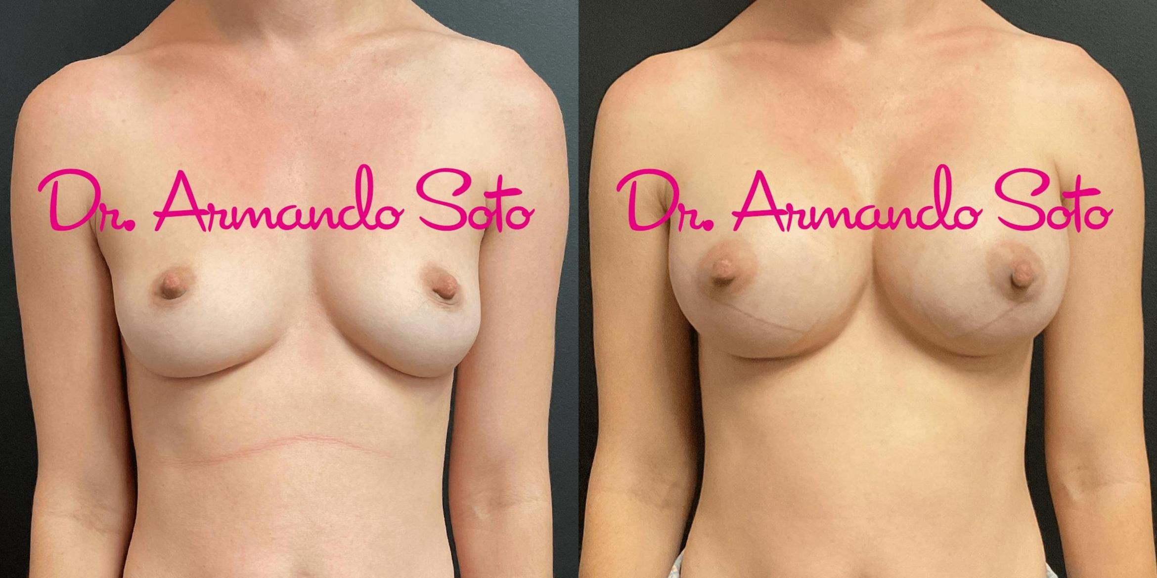 Before & After Breast Augmentation Case 73665 View #1 View in Orlando, FL