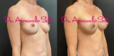 Before & After Breast Augmentation Case 73665 View #2 View in Orlando, FL