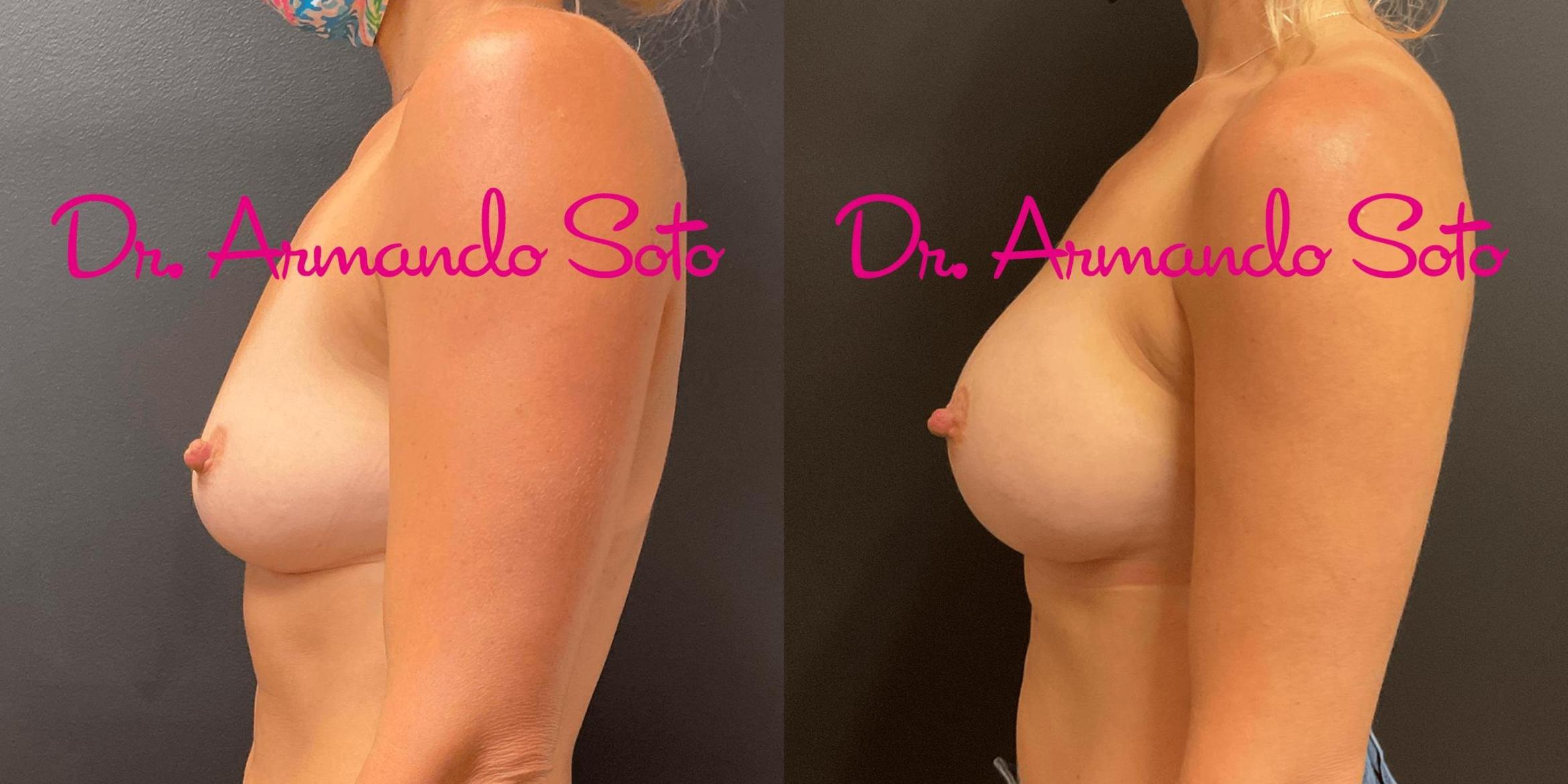Before & After Breast Augmentation Case 73828 View #2 View in Orlando, FL