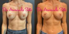 Before & After Breast Augmentation Case 74203 View #1 View in Orlando, FL