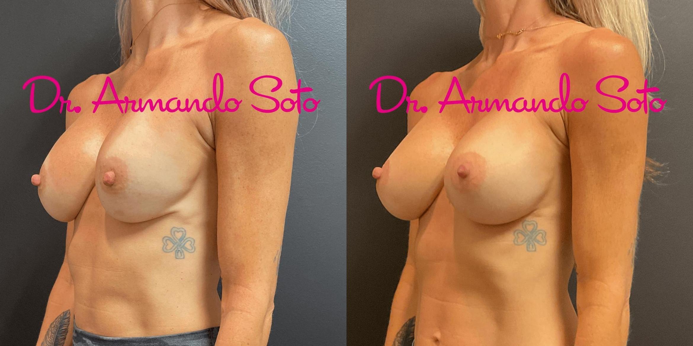 Before & After Breast Augmentation Case 74203 View #2 View in Orlando, FL
