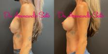 Before & After Breast Augmentation Case 74203 View #3 View in Orlando, FL