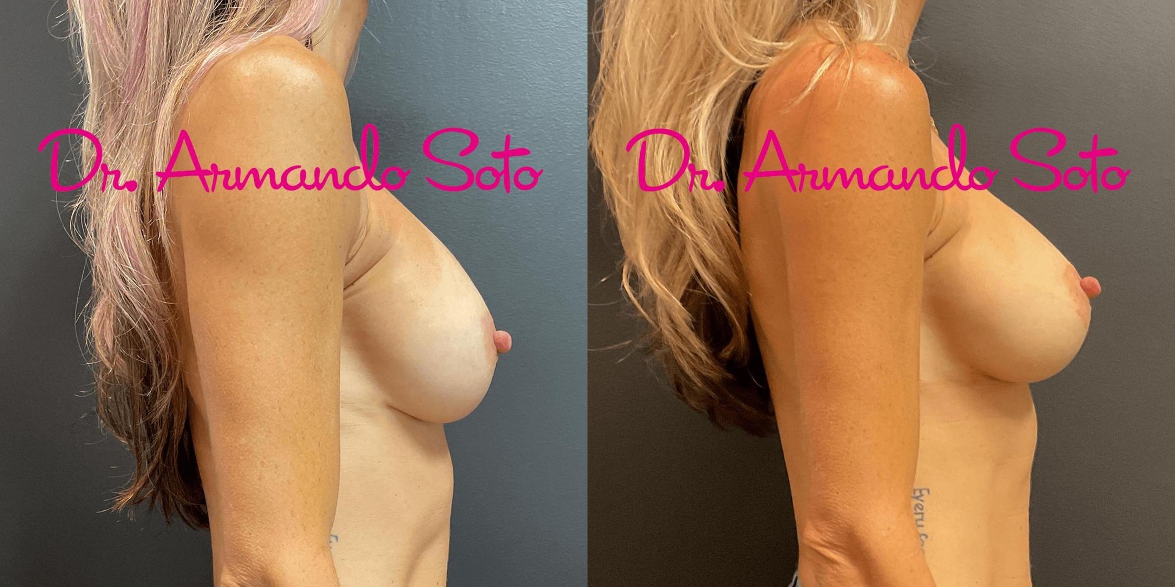 Before & After Breast Augmentation Case 74203 View #4 View in Orlando, FL