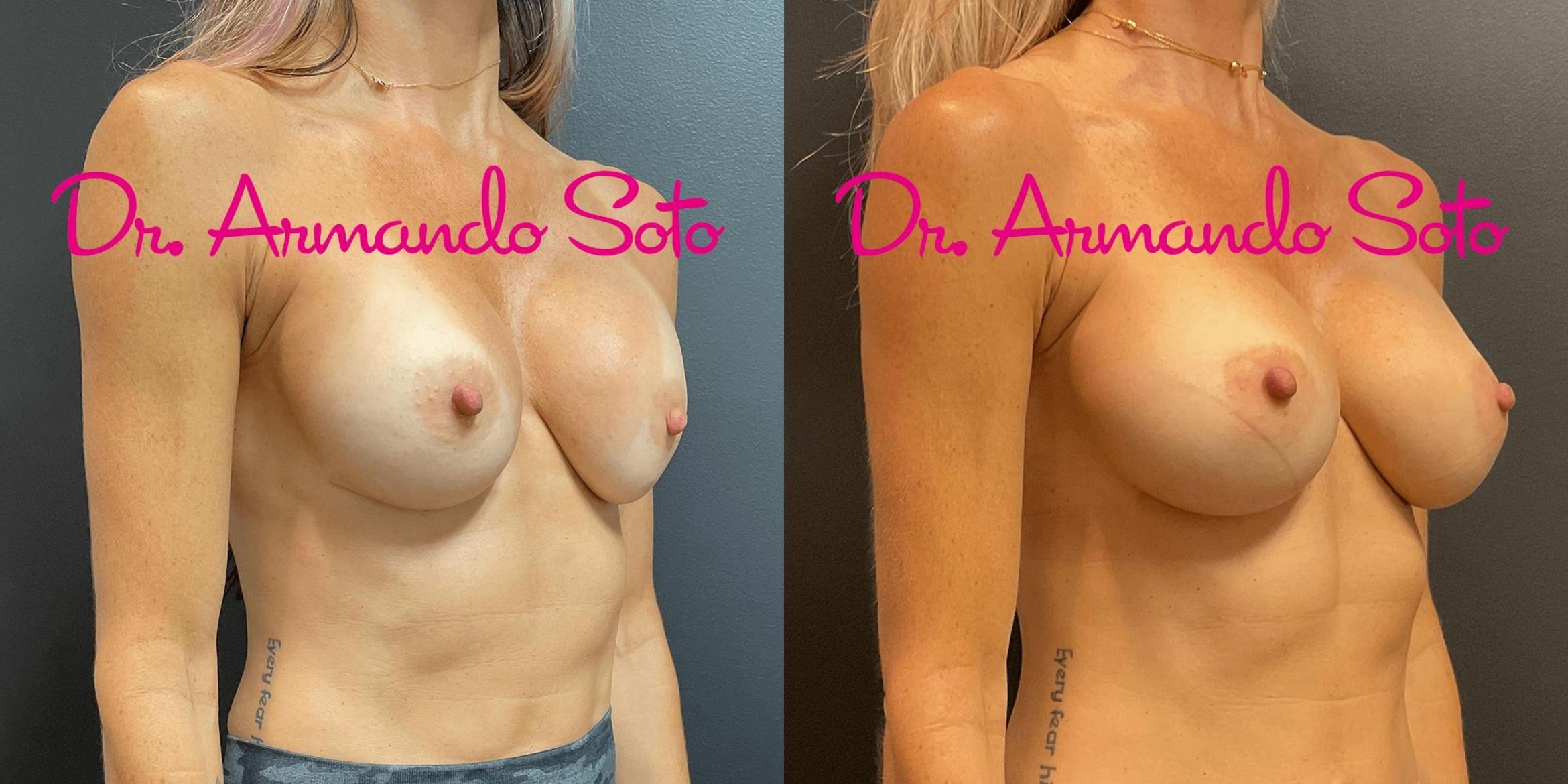 Before & After Breast Augmentation Case 74203 View #5 View in Orlando, FL