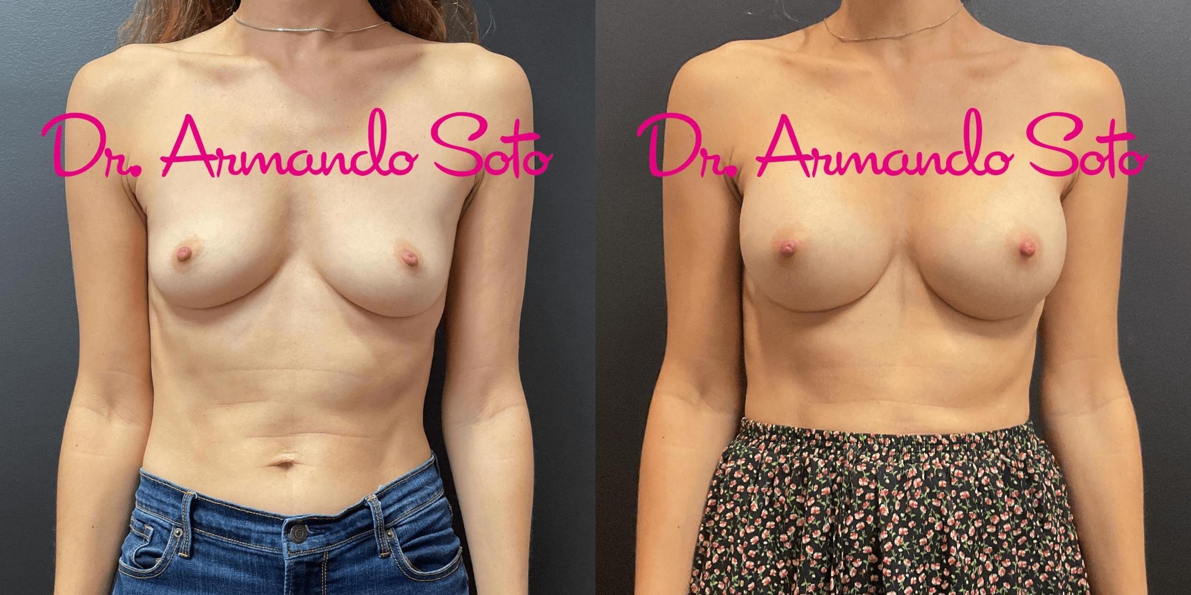 Before & After Breast Augmentation Case 74617 View #1 View in Orlando, FL
