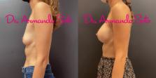 Before & After Breast Augmentation Case 74617 View #2 View in Orlando, FL