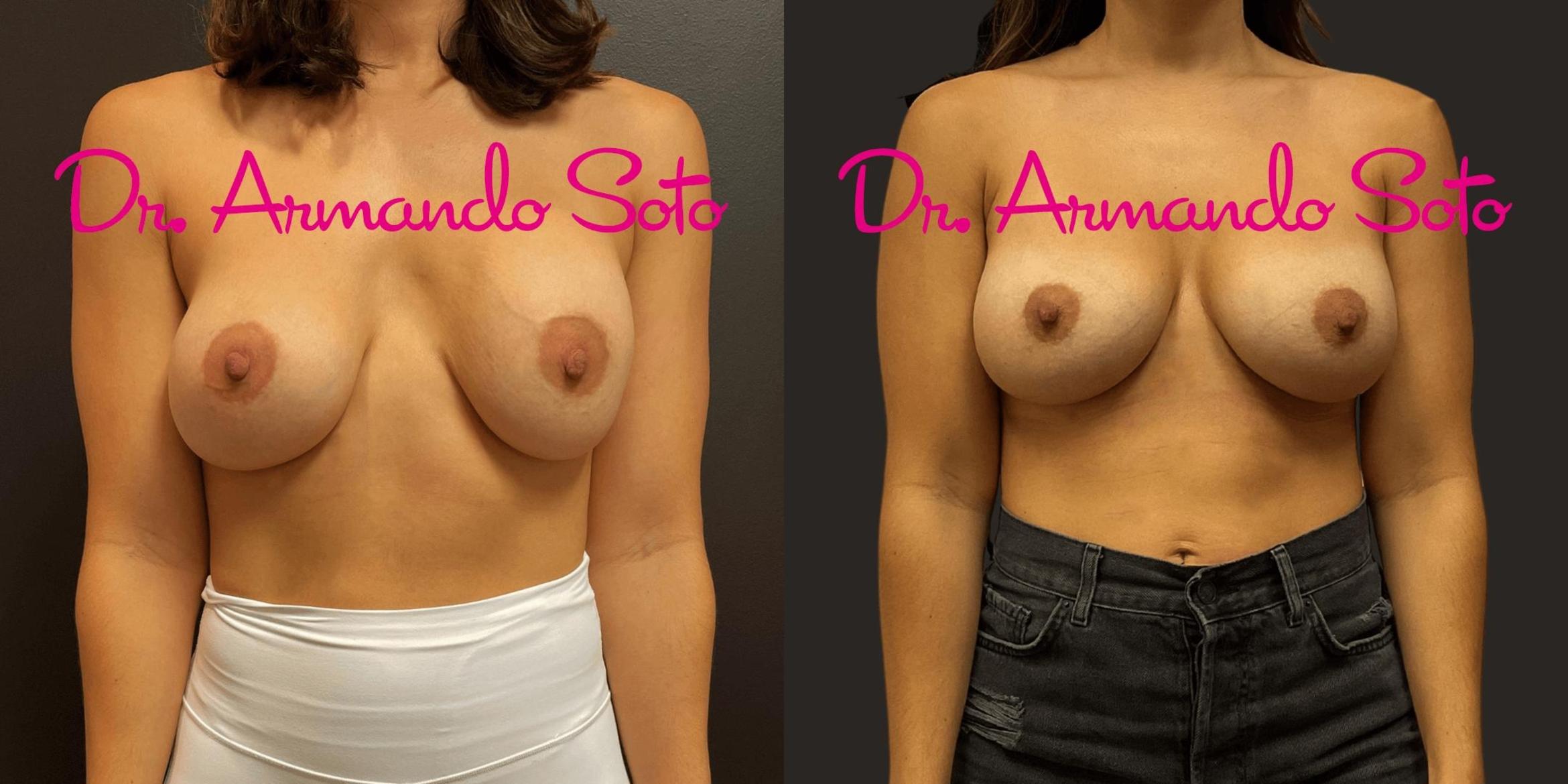 Before & After Breast Augmentation Case 75059 View #1 View in Orlando, FL
