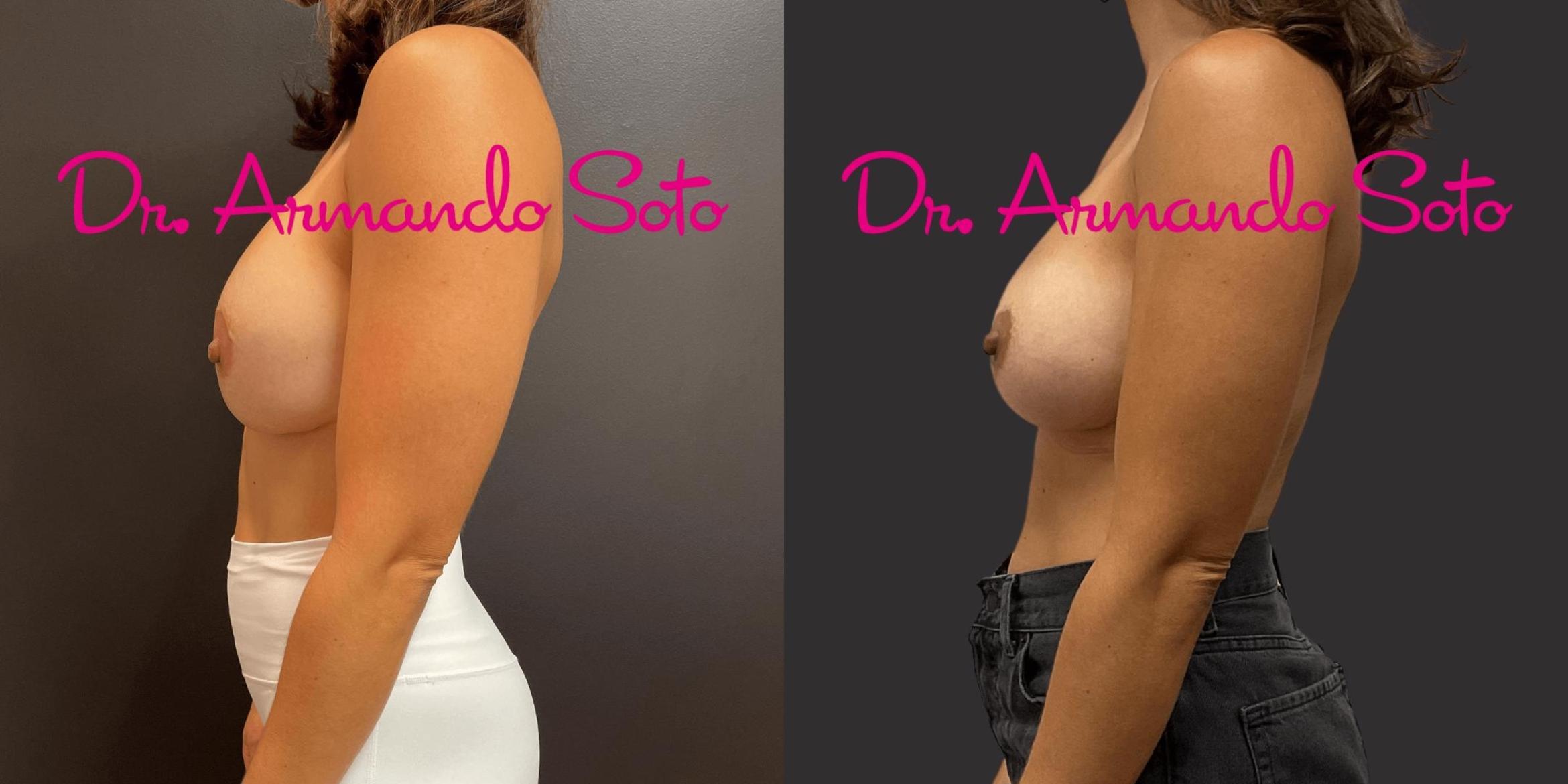 Before & After Breast Revision Case 75059 View #2 View in Orlando, FL