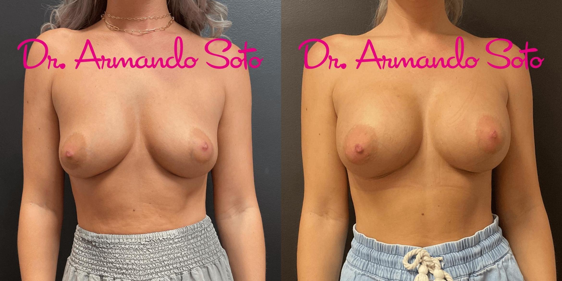 Before & After Breast Augmentation Case 75931 View #1 View in Orlando, FL