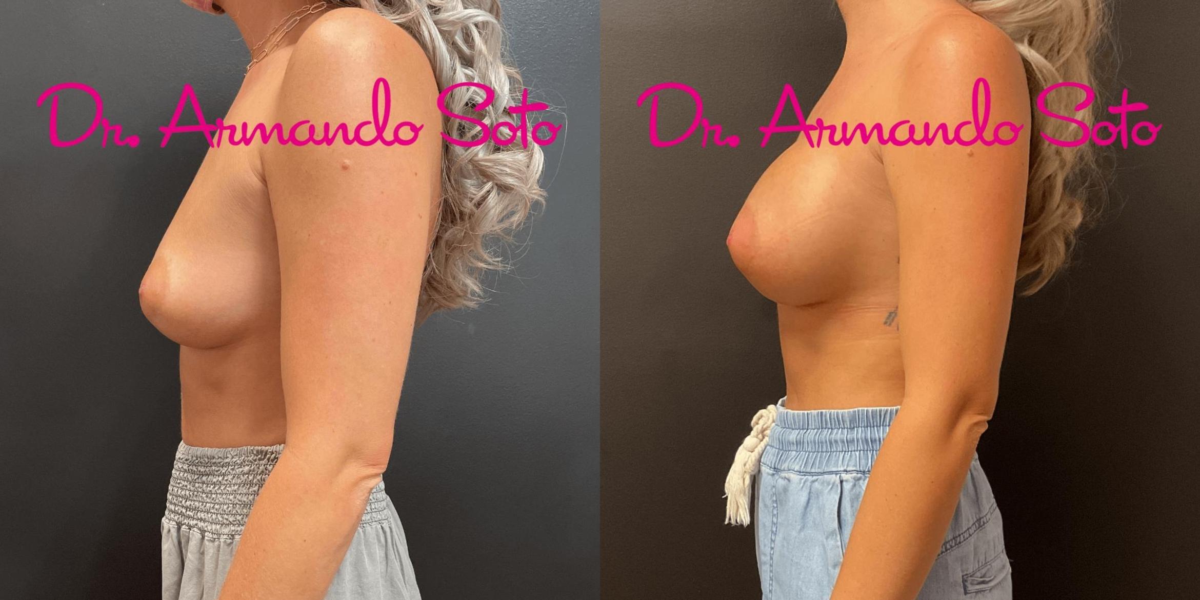 Before & After Breast Augmentation Case 75931 View #2 View in Orlando, FL