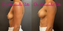Before & After Breast Augmentation Case 76277 Left Side View in Orlando, FL