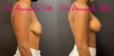 Before & After Breast Augmentation Case 76277 Right Side View in Orlando, FL