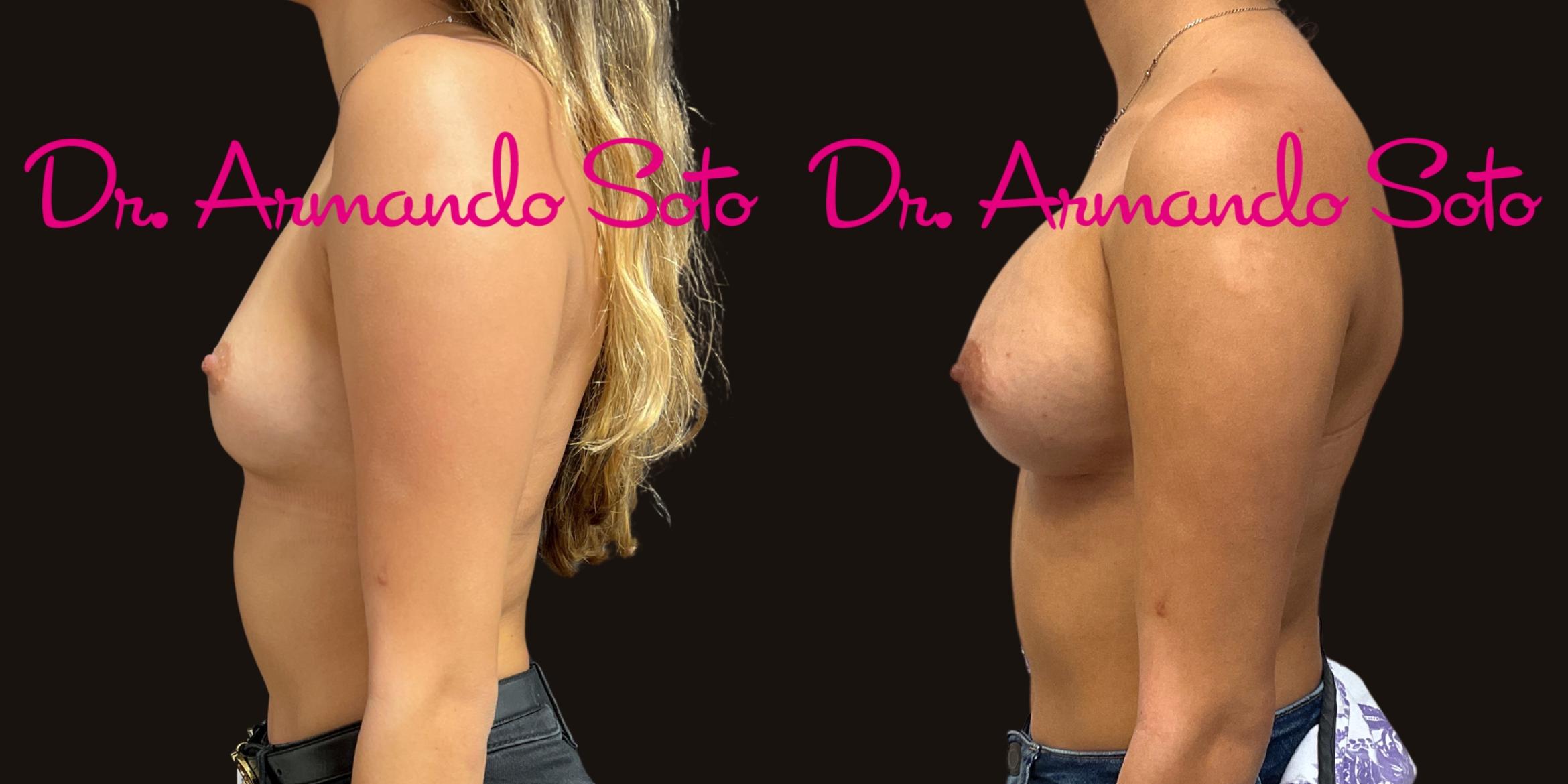 Before & After Breast Augmentation Case 76281 Left Side View in Orlando, FL