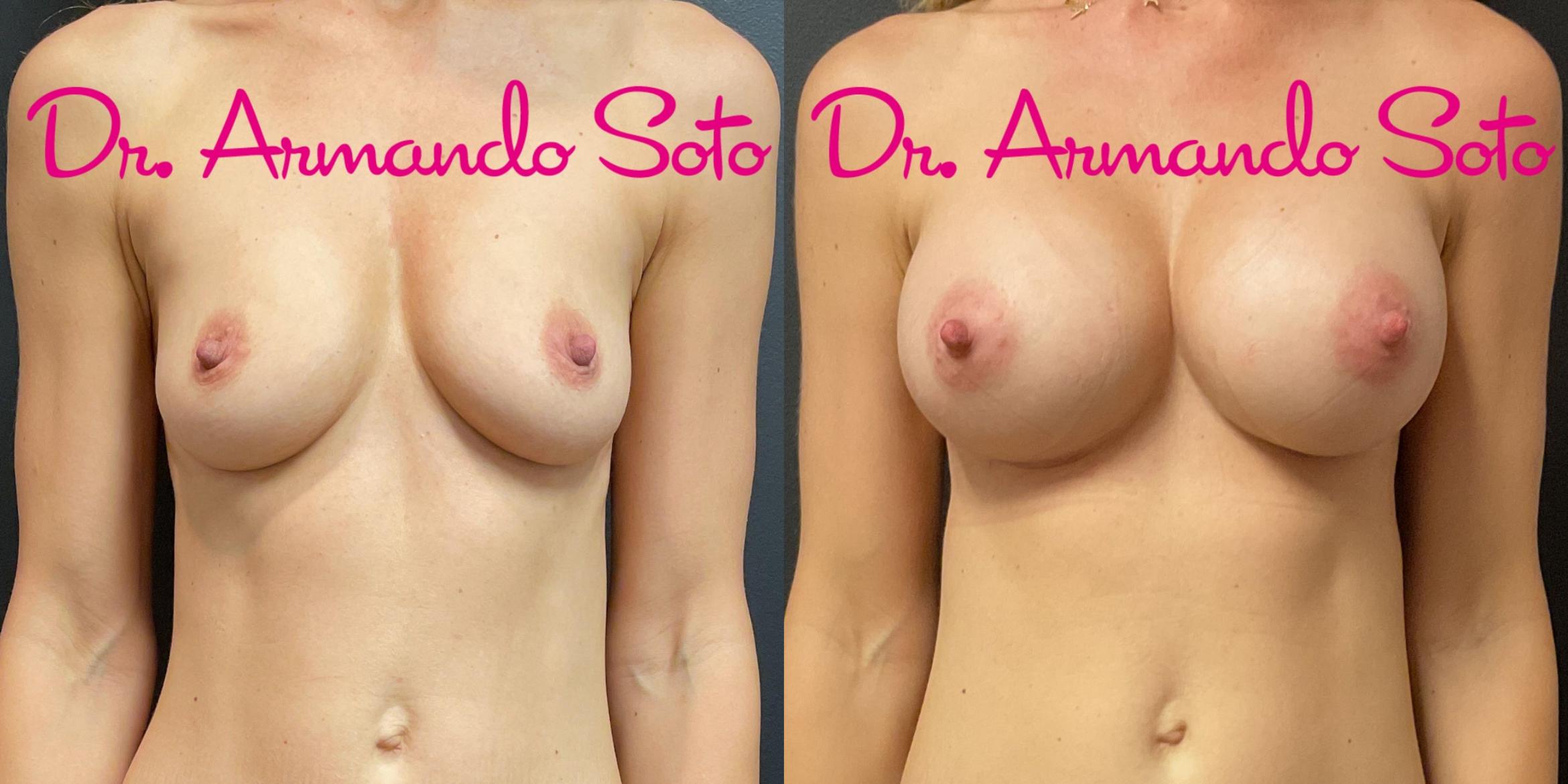 Before & After Breast Augmentation Case 76282 Front View in Orlando, FL