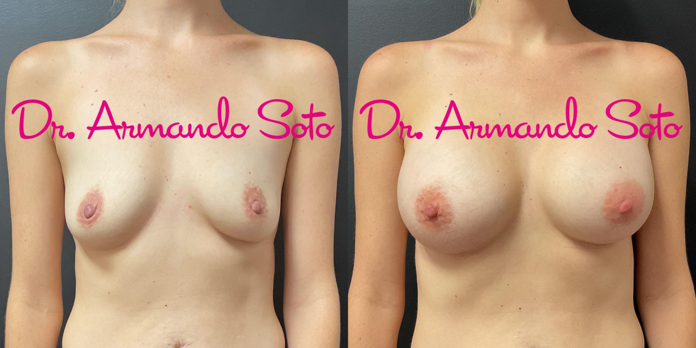 Before & After Breast Augmentation Case 76283 Front View in Orlando, FL