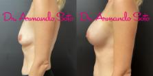 Before & After Breast Augmentation Case 76283 Left Side View in Orlando, FL