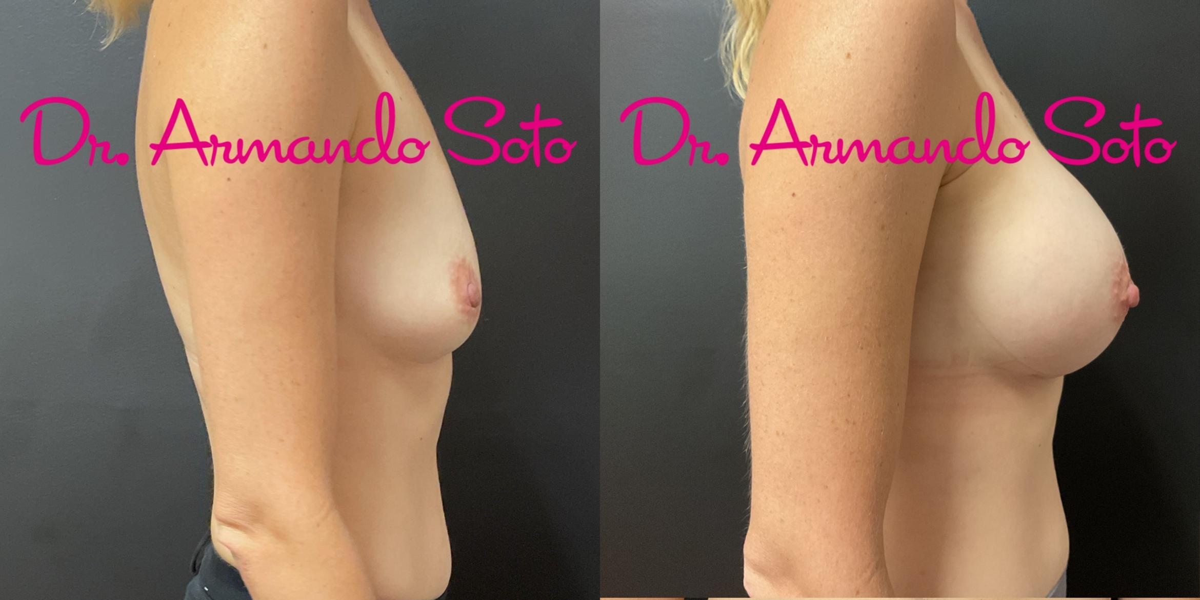 Before & After Breast Augmentation Case 76283 Right Side View in Orlando, FL