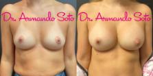 Before & After Breast Augmentation Case 76286 Front View in Orlando, FL