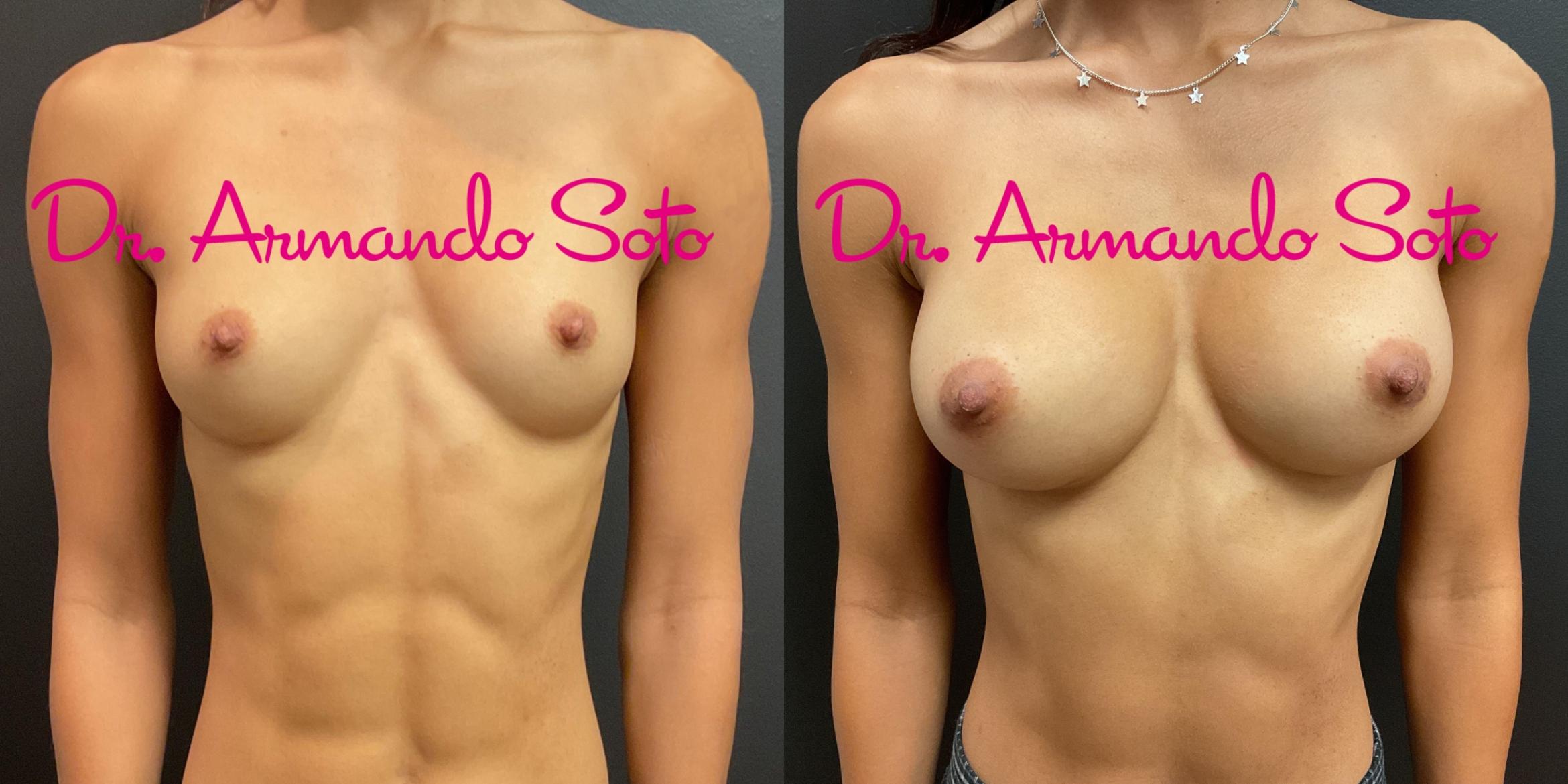 Before & After Breast Augmentation Case 76293 Front View in Orlando, FL