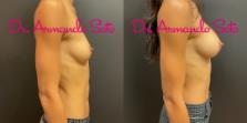 Before & After Breast Augmentation Case 76293 Right Side View in Orlando, FL