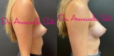 Before & After Breast Augmentation Case 76306 Right Side View in Orlando, FL