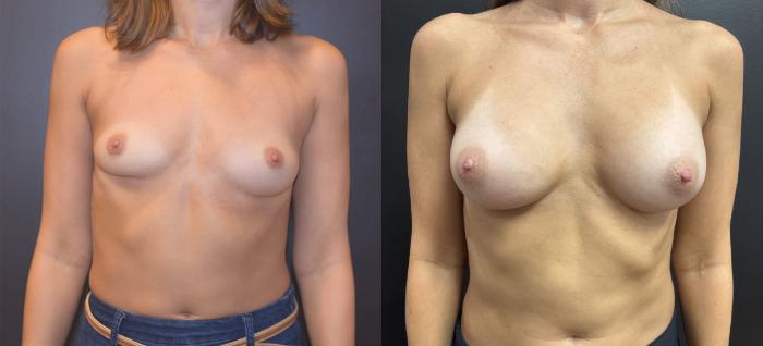 Before & After Breast Augmentation Case 76323 Front View in Orlando, FL