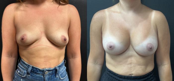 Front view before breast augmentation with Dr. Armando Soto