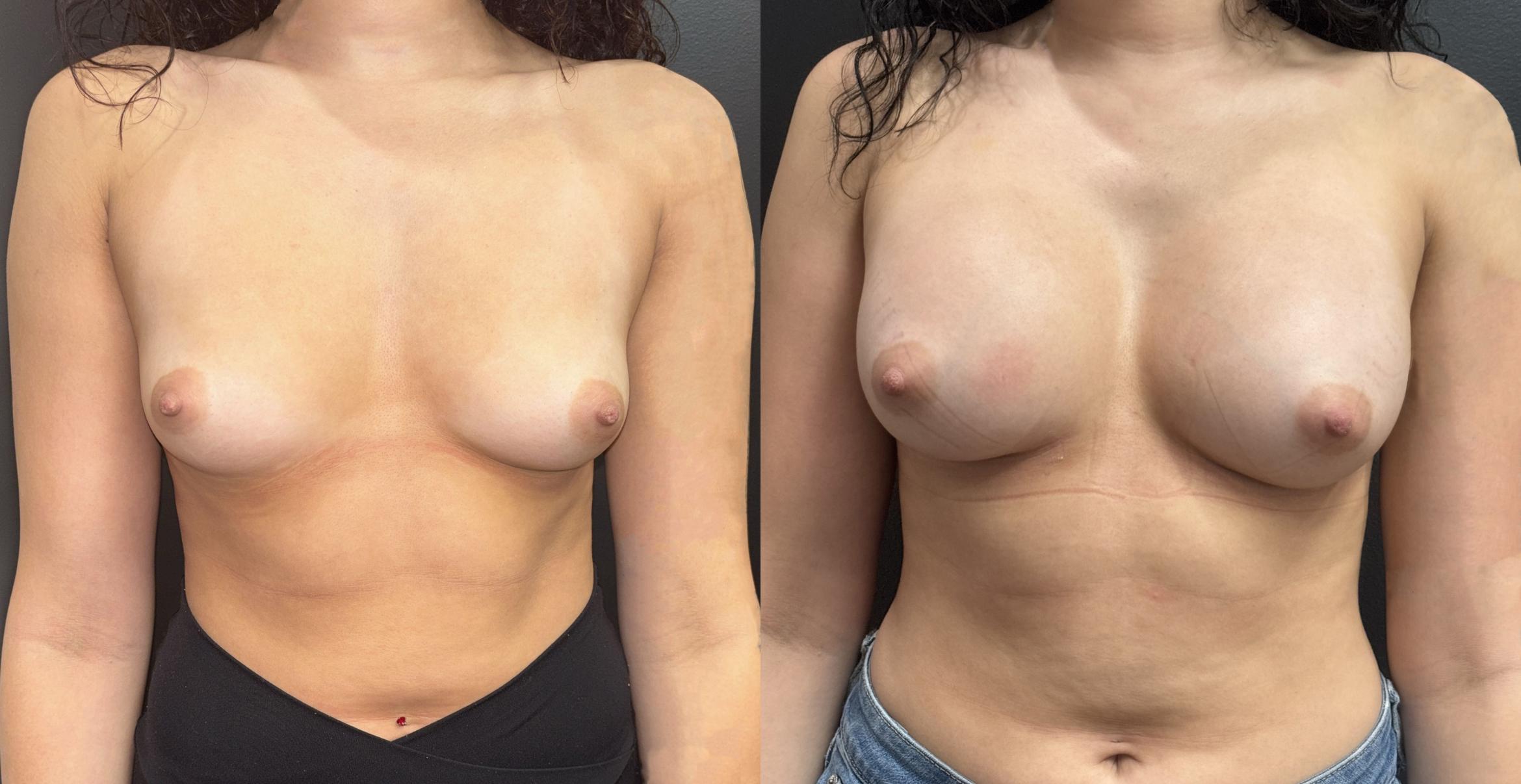 Before and after Images of young woman who had breast augmentation with Dr. Soto in Orlando