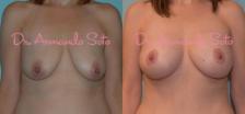 Before & After Breast Augmentation with Lift Case 23700 View #1 View in Orlando, FL