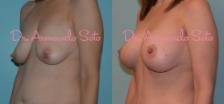 Before & After Breast Augmentation with Lift Case 23700 View #2 View in Orlando, FL