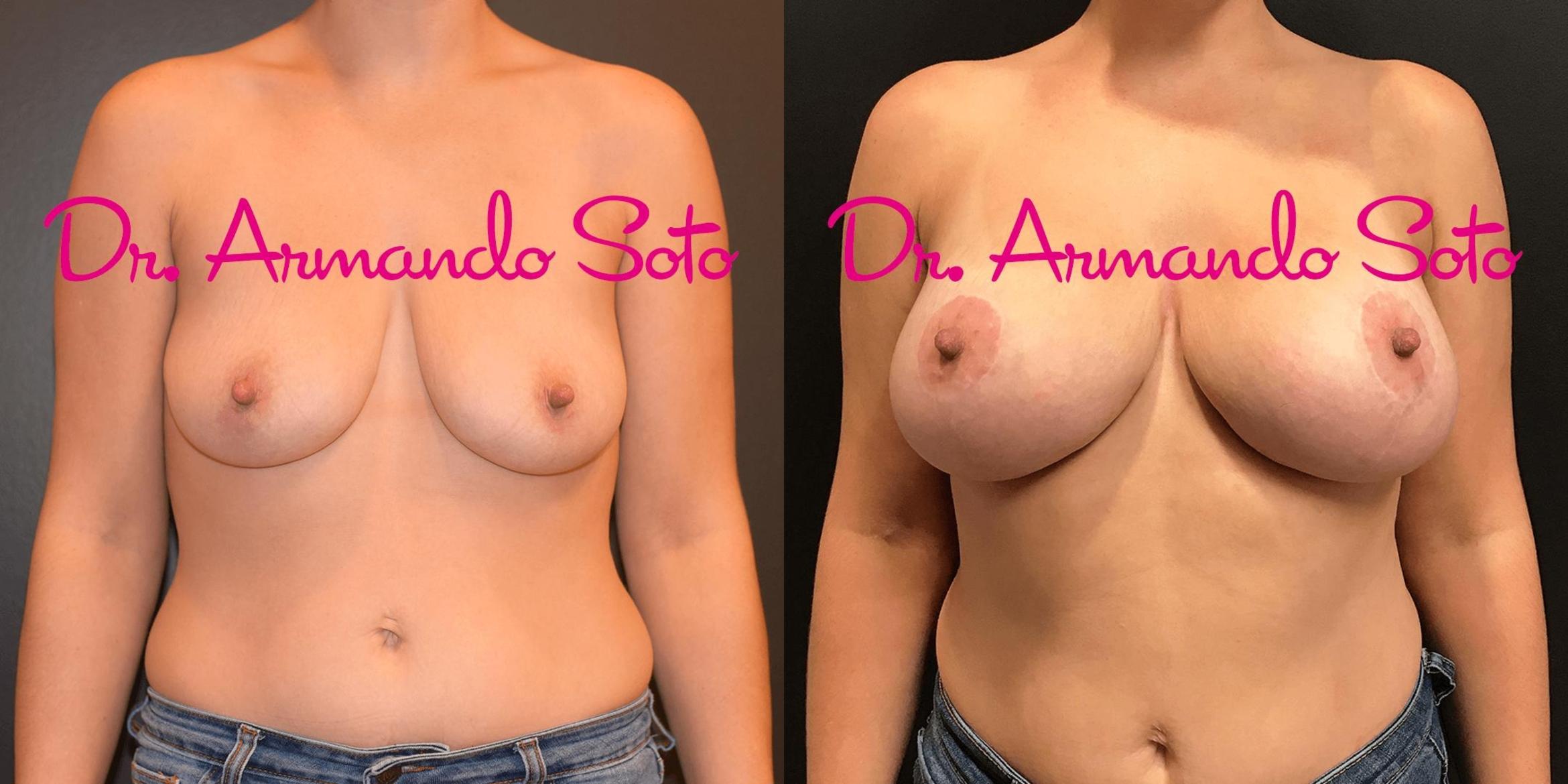Before & After Breast Augmentation with Lift Case 70822 View #1 View in Orlando, FL