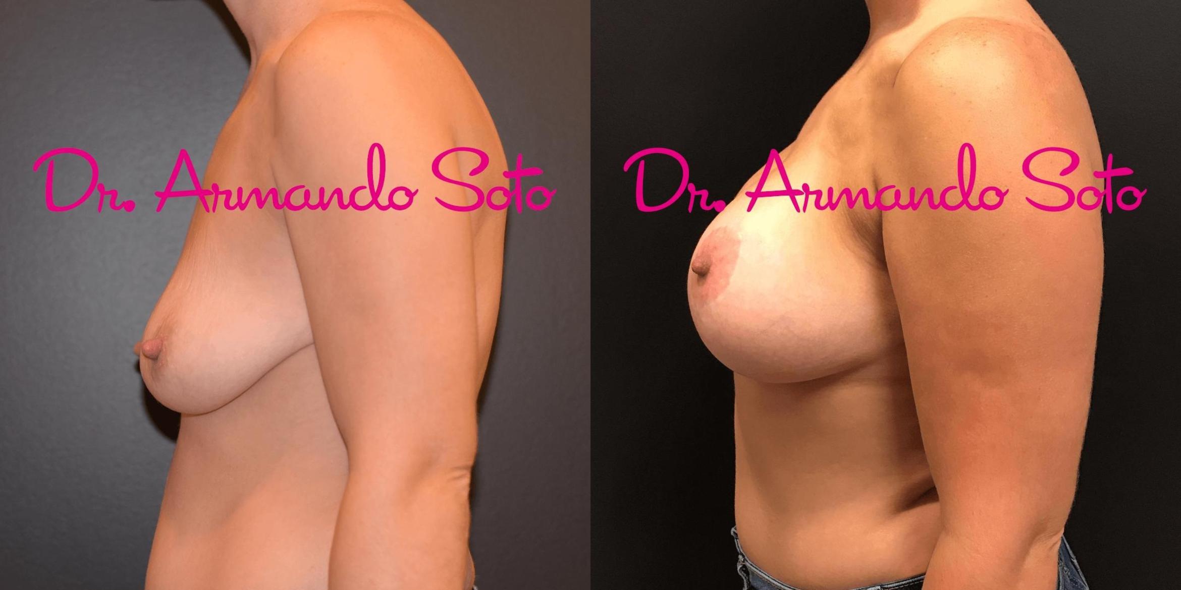 Before & After Breast Lift Case 70822 View #2 View in Orlando, FL