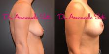 Before & After Breast Augmentation with Lift Case 70822 View #3 View in Orlando, FL