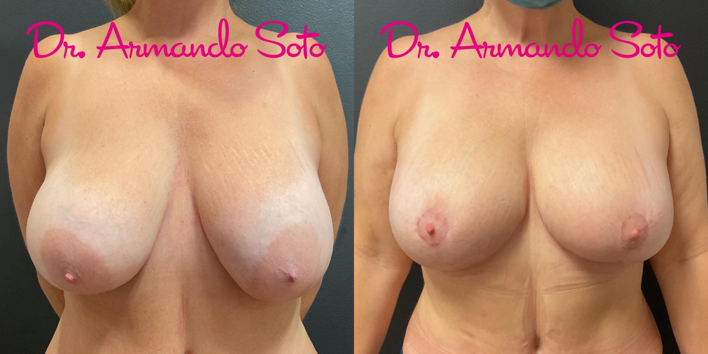 Before & After Breast Augmentation with Lift Case 76296 Front View in Orlando, FL