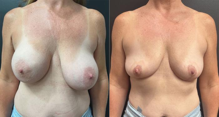 Before & After Breast Implant Removal Case 76325 Front View in Orlando, FL